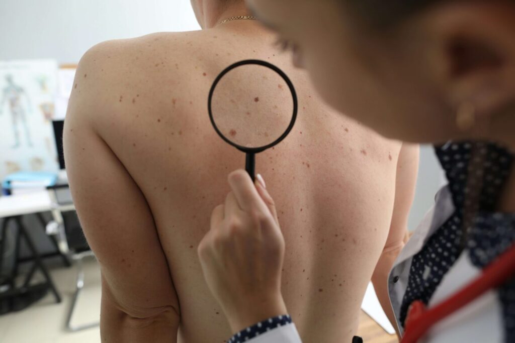 Melanoma the world's second cancer: alarming rise in cases in the last decade 2gentlewoman - Prevention
